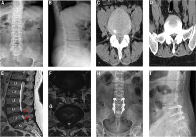 The treatment effect of posterior lumbar fusion surgery on patients suffering from lumbar disc herniation concurrent with peroneal nerve paralysis